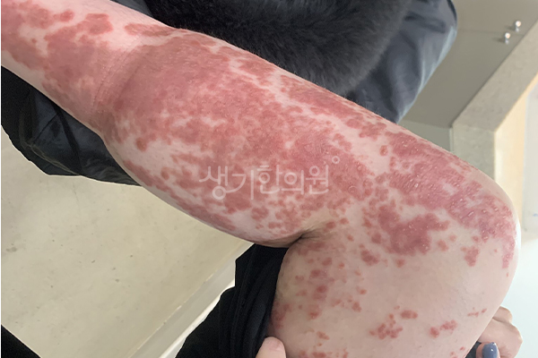 생기한의원 건선 치료 전 증상 사진